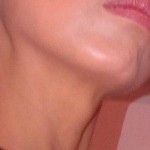 Excellent and undetectable chin contouring